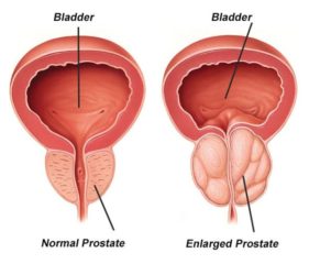 endoscopic prostate surgery in indore