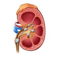 kidney stone laparoscopic surgery in indore