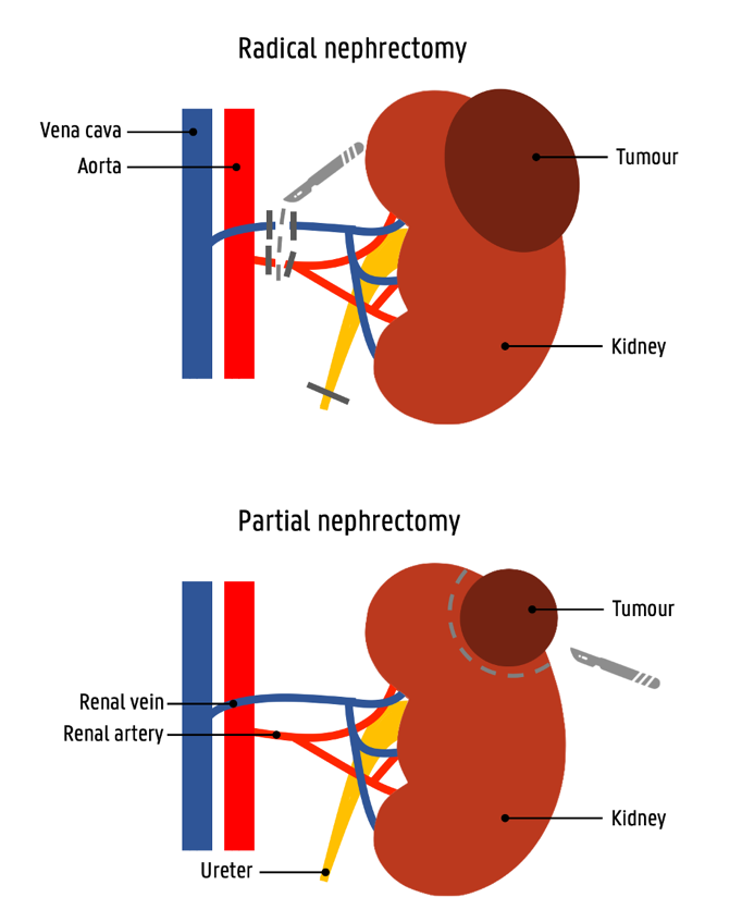 laparoscopic-radical-nephrectomy-for-renal-cancer-urologist