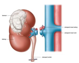 kidney cancer surgery in indore