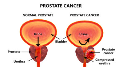 prostate cancer treatment in indore