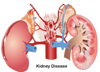 kidney disease treatment in indore