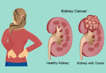 kidney cancer treatment in indore