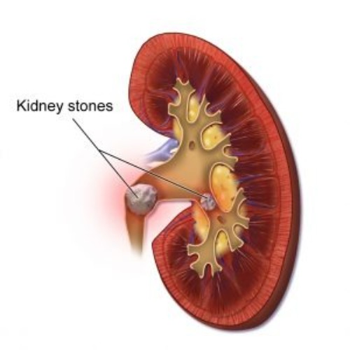 kidney stone treatment in mumbai